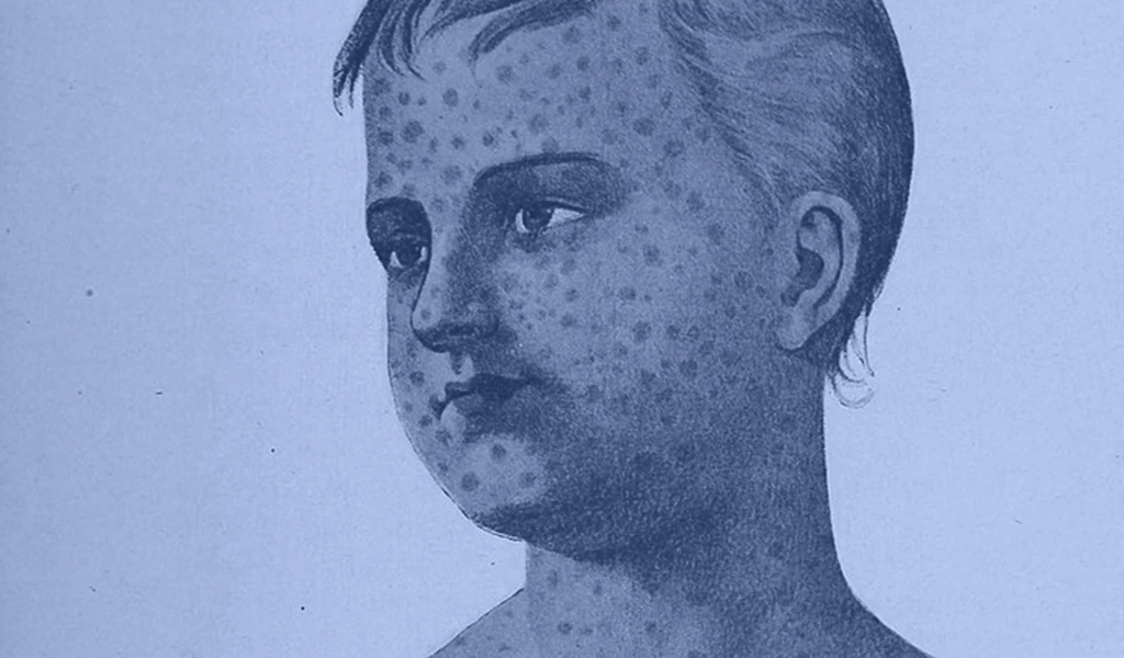 closeup historic poster of someone with chickenpoxs