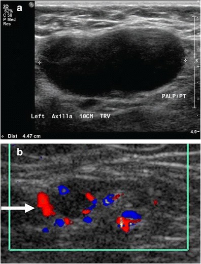 Medical ultrasonography of a soft tissue lump, showing signs of a suspected malignant lymph node:- Doppler ultrasonography that shows hyperaemic blood flow in the hilum and central cortex and/or abnormal (non-hilar cortical) blood flow- Increased focal cortical thickness greater than 3 mm - Absence of the fatty hilum